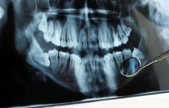 Dental X-ray of impacted wisdom teeth